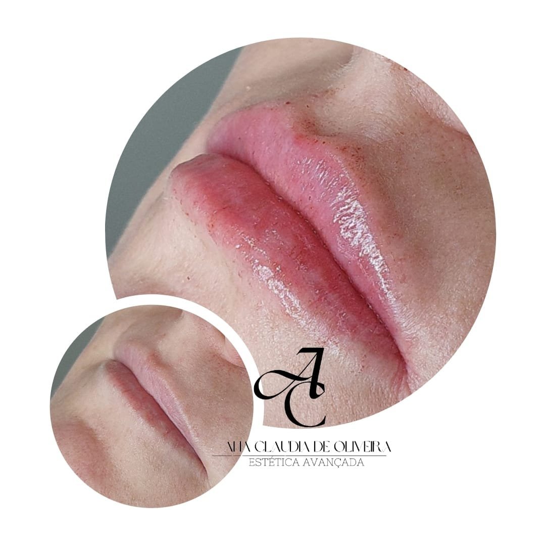 Resultado real de desenho de lábios da Dra. Ana Claudia, close do contorno labial