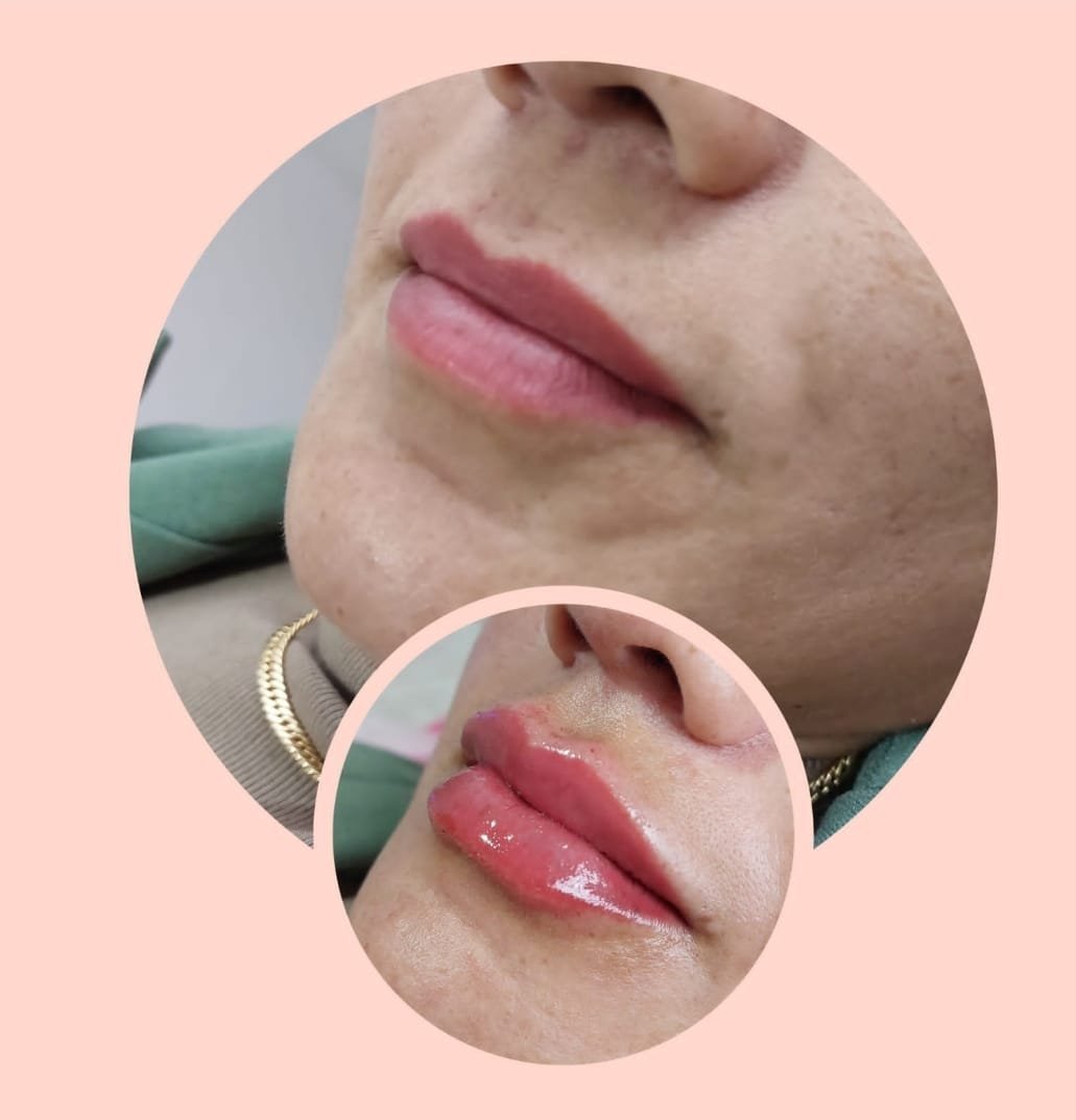 Antes e depois de desenho de lábios da Dra. Ana Claudia